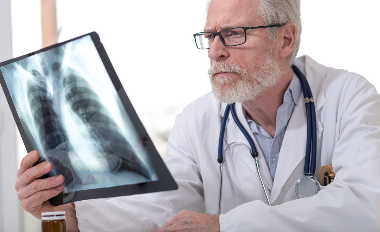 CT单上面考虑肺ca就是肺癌吗?看看医生怎么说