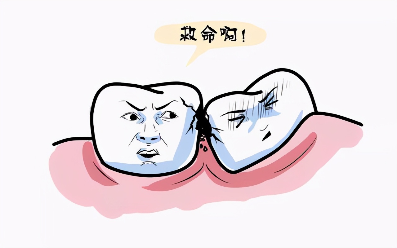 智齿埋在牙床内,容易引起牙周炎,且影响第二磨牙寿命,建议拔掉,长痛不