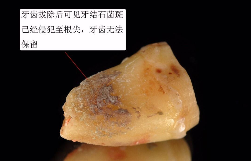 牙釉质脱落要重视,别因为侥幸毁了一口牙