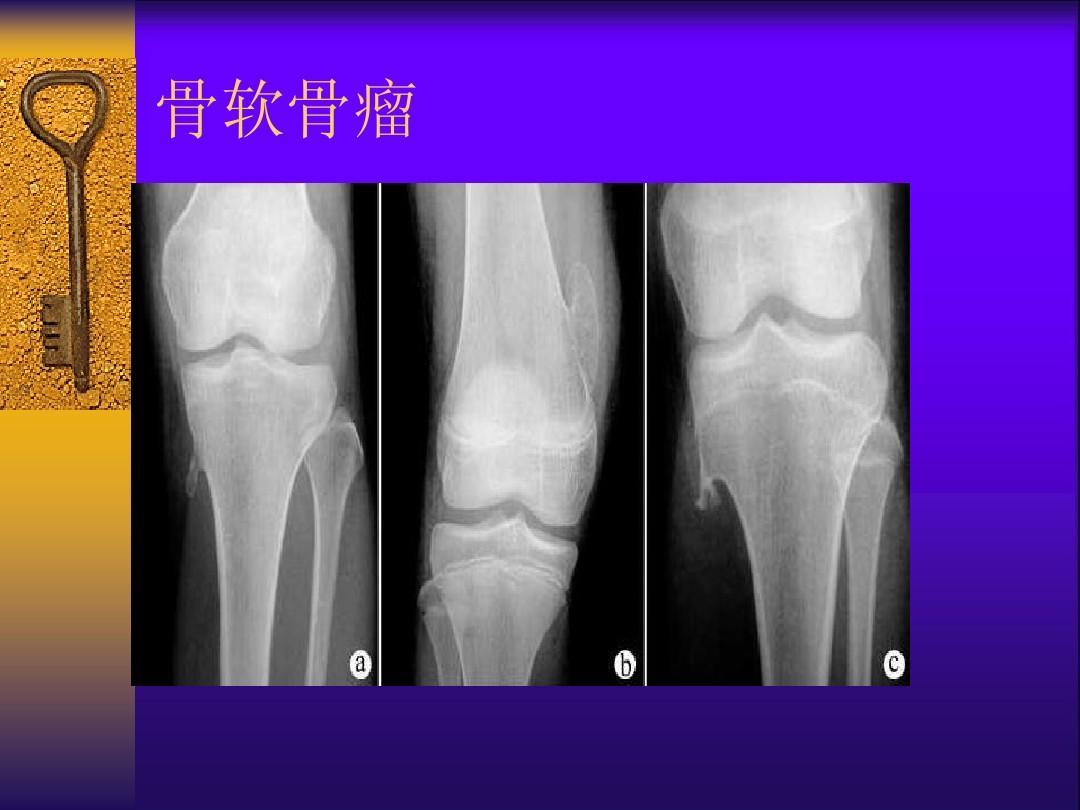 骨软骨瘤的检查措施有哪些