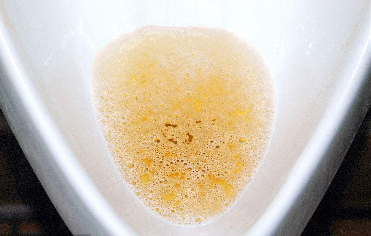 早期肝硬化的"3大类症状"答案都在脸上,注意观察