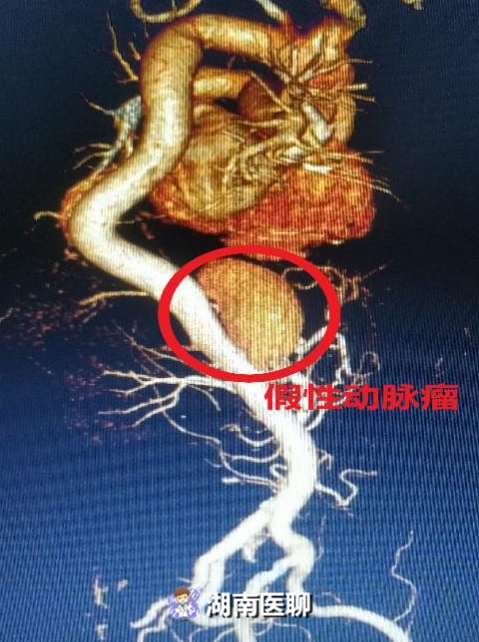 老翁肚里揣“不定时炸弹”，专家历时一小时用这种“钉子”巧拆除