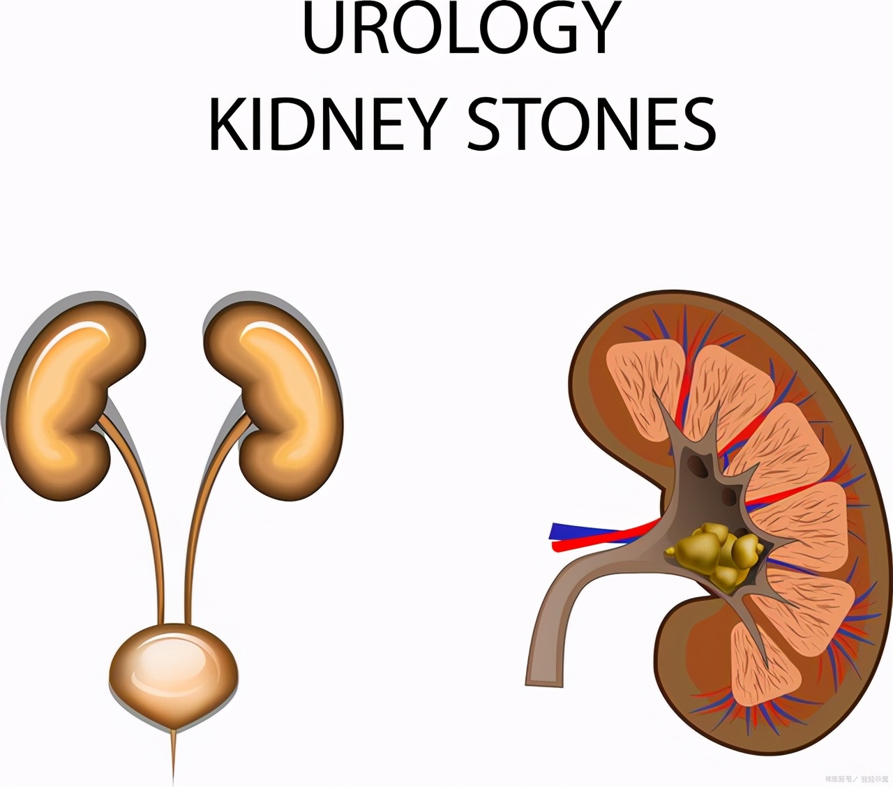 让人痛不欲生的泌尿结石是怎么形成的？杜绝结石，教你3件事