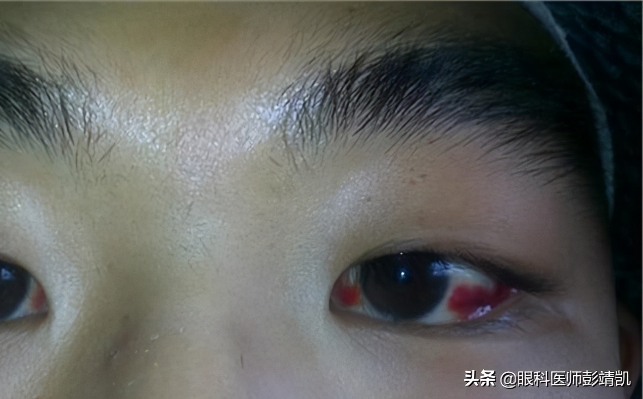 眼球发红充血怎么回事(眼球发红充血怎么缓解) -新时代资讯