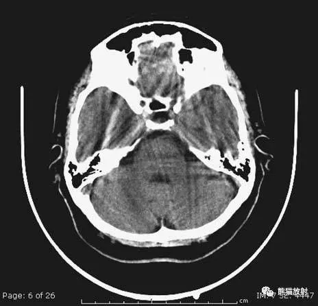 简明又详细的头部CT读片详解，收藏