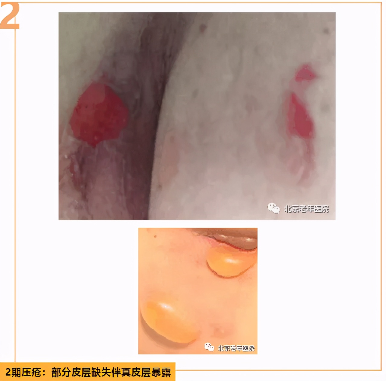 居家照护者如何识别早期压疮？