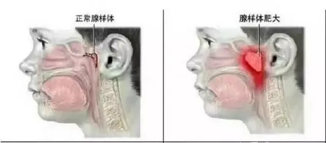 孩子腺样体肥大怎么办？家长必知的治疗与护理指南