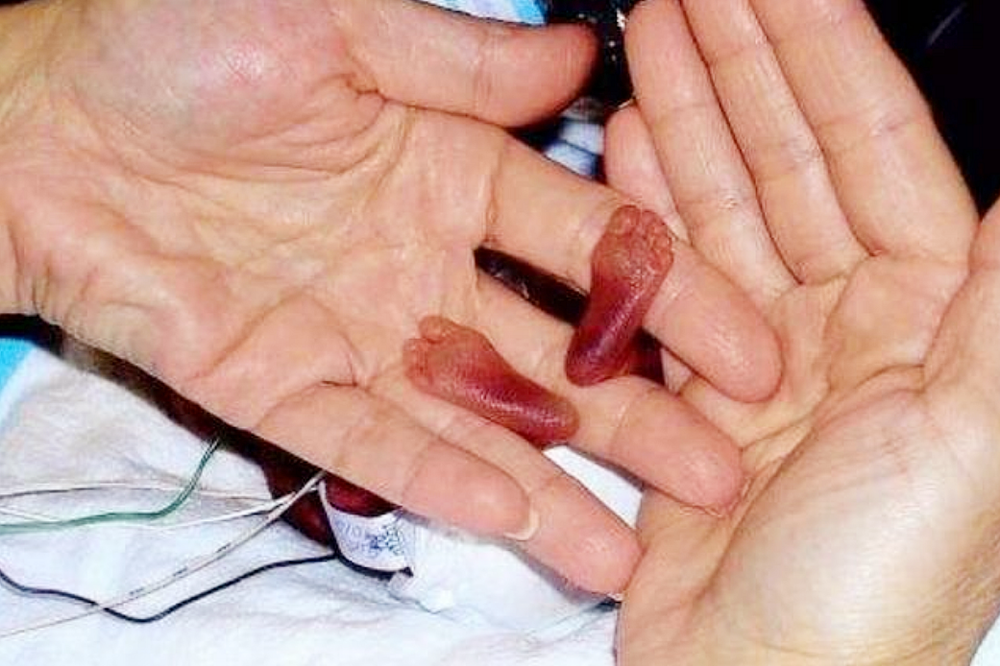 全世界"最小的新生儿",圆珠笔一样大,网友称:真是一个奇迹