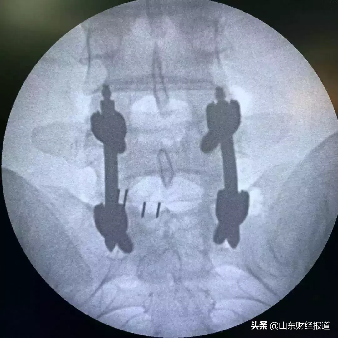 第三节 单纯一期后路病灶清除椎体间植骨融合内固定治疗胸椎结核-外科学-医学