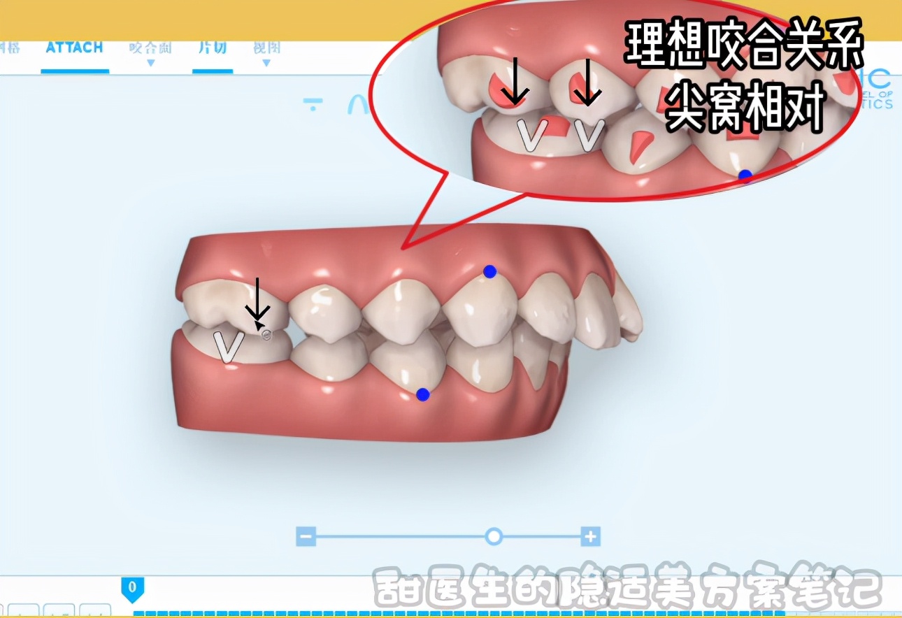 下颌后缩、咬合不对位，能用隐适美矫正吗？曹甜博士视频讲解案例