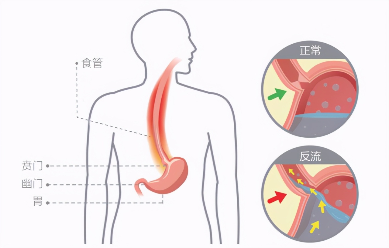 胃酸多不能长期吃奥美拉唑，日常饮食注意这4点，远离反酸烧心