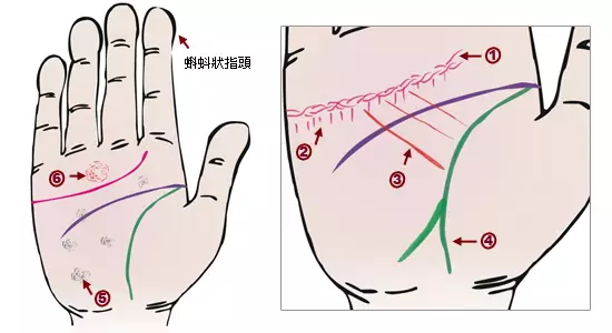 掌纹诊病：可以诊断肝癌、糖尿病、高血压、妇科病、脑溢血