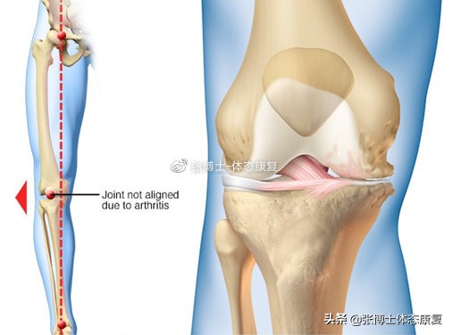 「运动康复科普」关节积液的出现机制与康复治疗