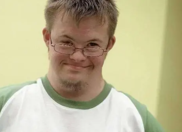 超雌综合征外貌