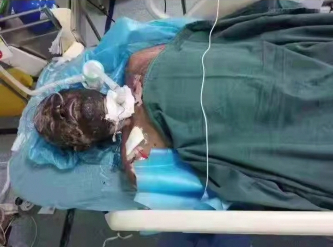 嘉兴男子钓鱼触碰高压电，衣服和头发都烧没了，脸变漆黑