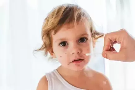 水痘的图片(奇痒、可留疤、高传染，孩子起水痘时，家长应该这样做)