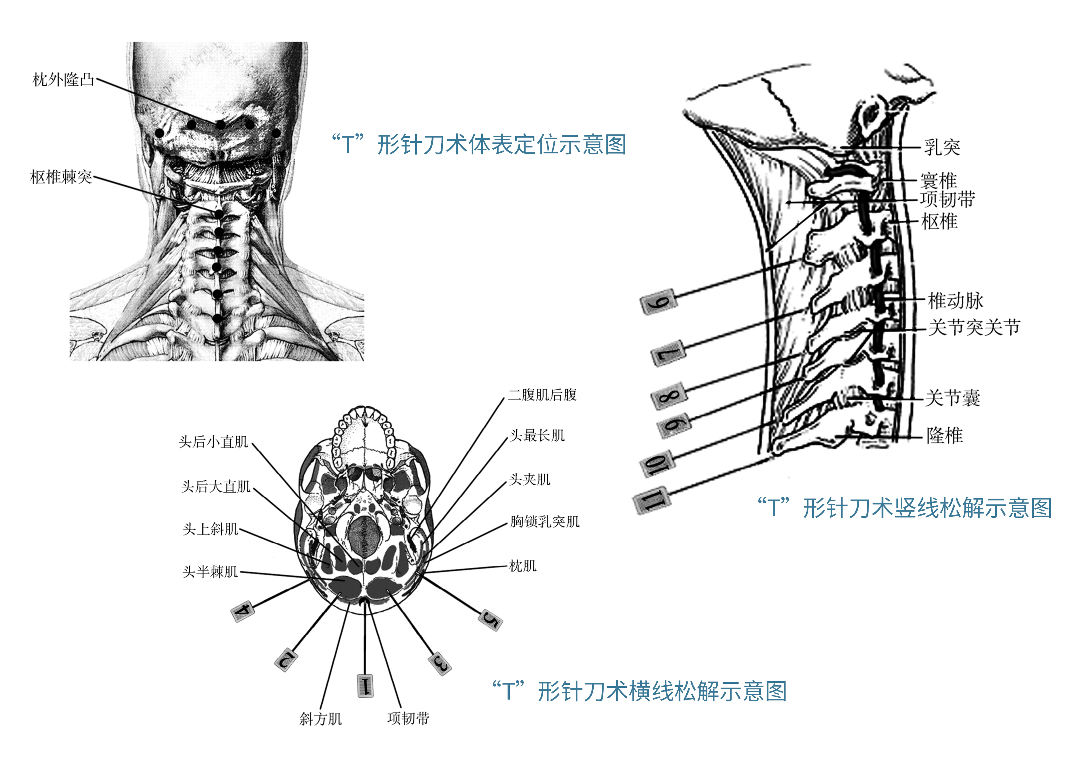 小针刀治疗颈椎病是骗人的吗？医生告诉你真相
