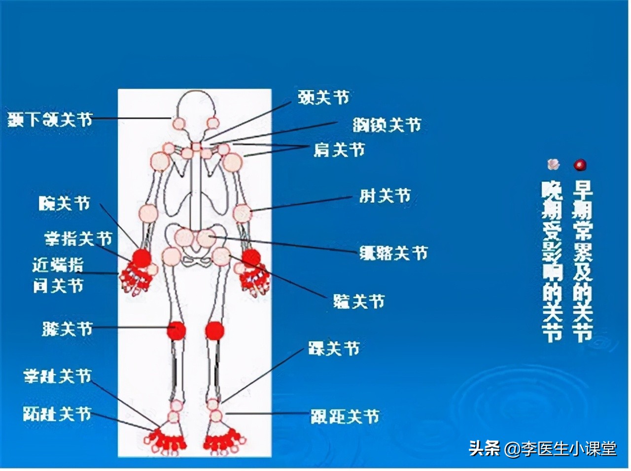 40岁王女士，长期肩膀疼痛，但并非肩周炎，究竟问题出在哪里？
