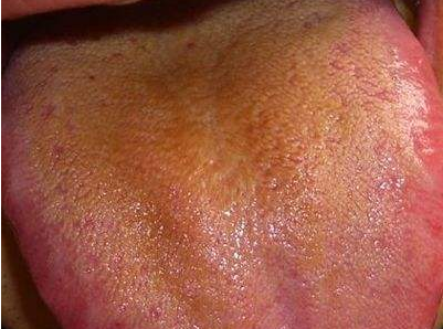 舌炎的症状图片(舌苔增厚) - 赤虎壹号