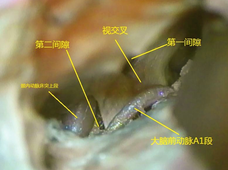 锁孔入路处理大脑中动脉瘤