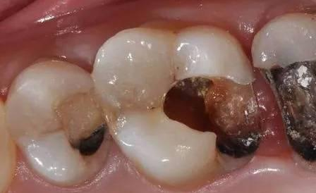 1,表面有较小的深色点——浅龋.