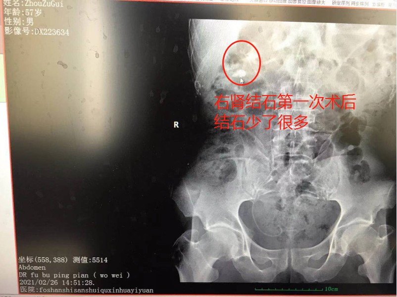 突发腰痛别小视！湖北大叔突感腰痛经查结石严重致肾功能受损