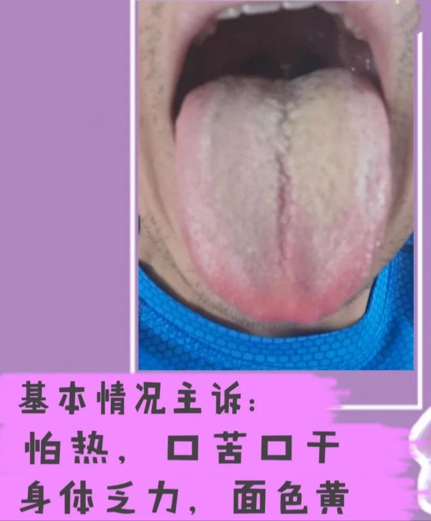 舌头有裂纹是怎么回事？常见的裂纹舌辩证，看看你是哪一种？