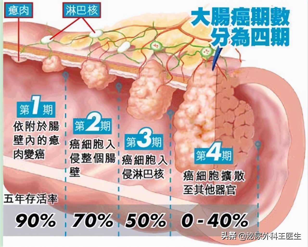 一天3、4次大便，便血5个月，男子查出肠癌晚期：有病不能拖