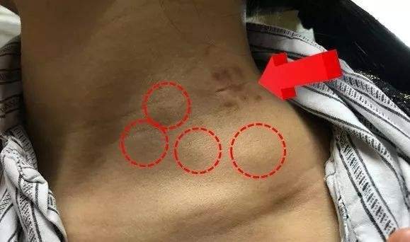 癌症已经有淋巴结转移,做手术还有意义吗?是不是只能等死了