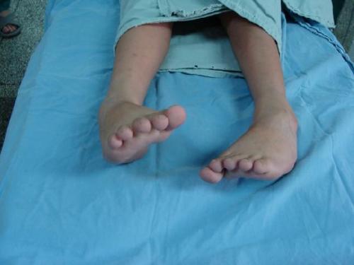 脑瘫的早期婴儿手指图(为什么肢体畸形是脑瘫呢) 
