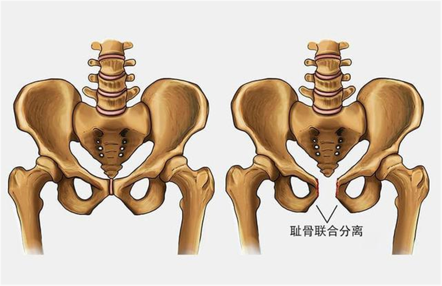 耻骨是哪个部位 耻骨疼的位置图片-文化号
