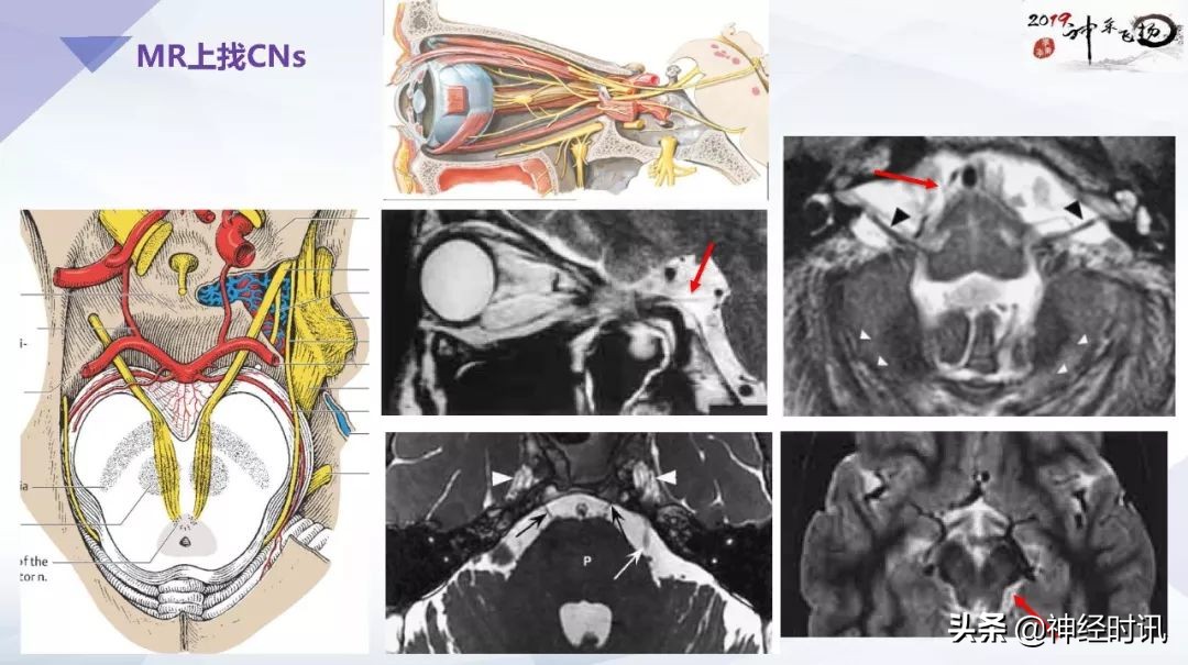 解剖&影像 | 颅神经的解剖基础和临床定位