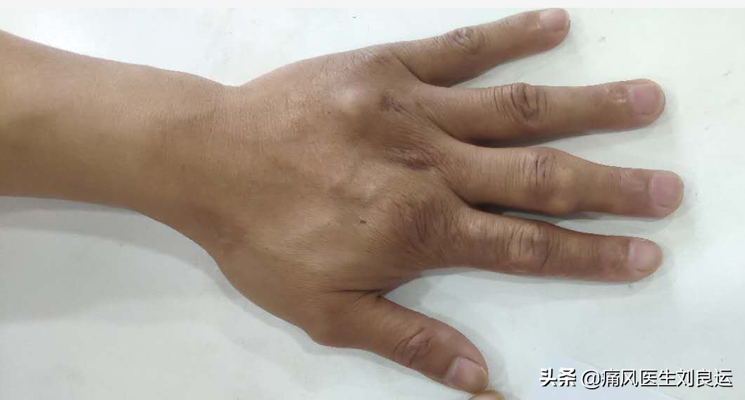 体检尿酸高不一定痛风发作，但你仍需了解血尿酸高的原因和危害