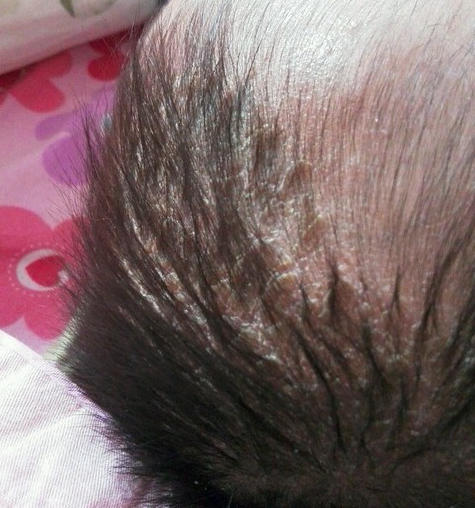 三个月婴儿头垢图片（清理头垢孩子会生病）