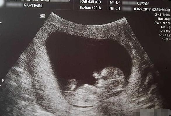 胚胎是什么样子的图片(女子怀孕14周流产) - 赤虎壹号