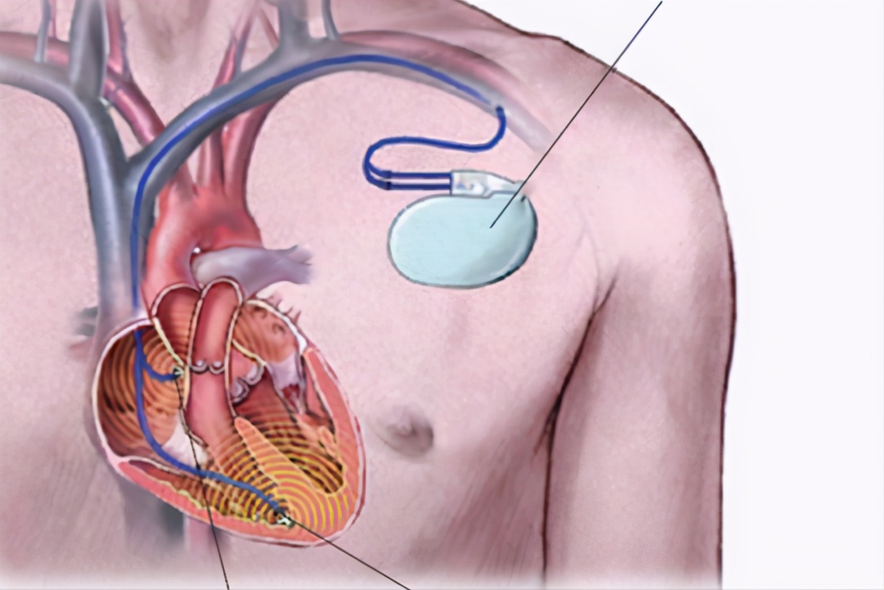 心脏不适就要装心脏起搏器?安装后有什么需要注意的?