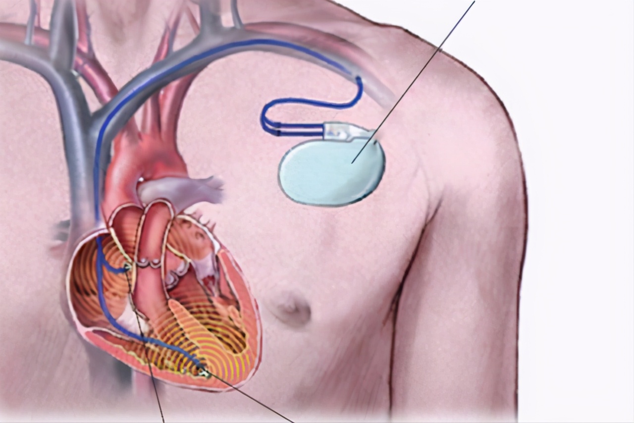 心脏不适就要装心脏起搏器？安装后有什么需要注意的？