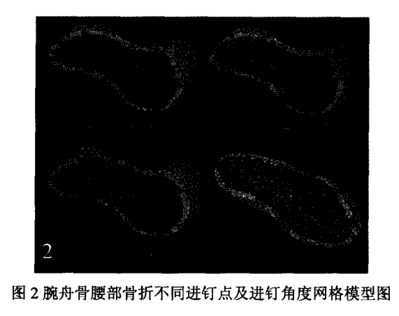 掌侧逆行固定治疗腕舟骨腰部骨折三维有限元分析