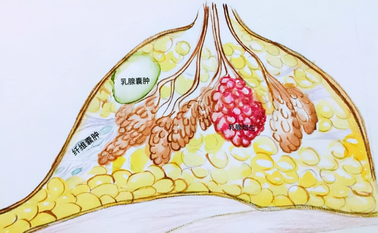 体检报告中的乳腺囊肿、甲状腺囊肿、卵巢囊肿……应如何看待？