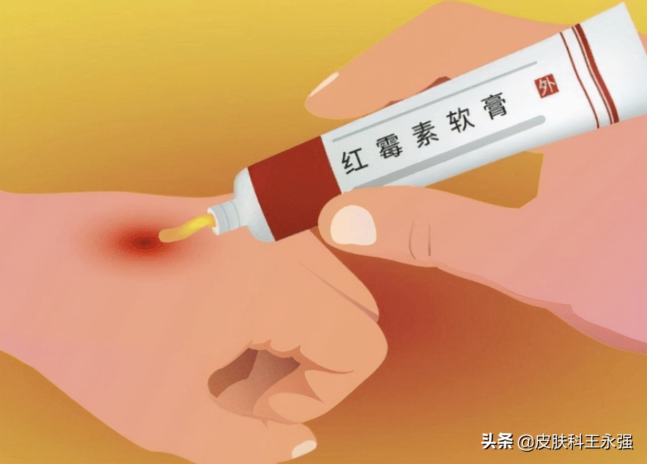 几块钱一支的红霉素软膏，解决皮肤病人的烦恼，早知早用早好