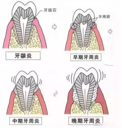 洗牙普通200，深度3000，深度洗牙是忽悠还是真的？