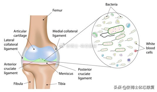 「运动康复科普」关节积液的出现机制与康复治疗