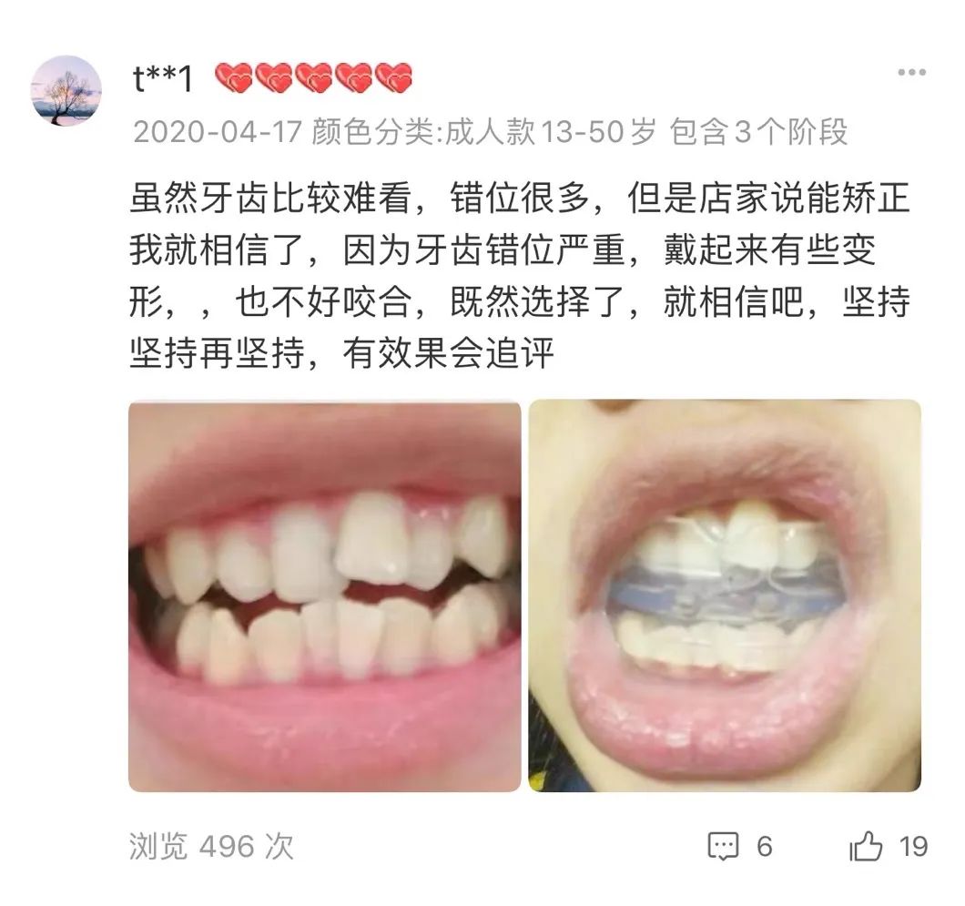 正畸日记 | 200元就能正畸？沉迷网购的你可能在交智商税