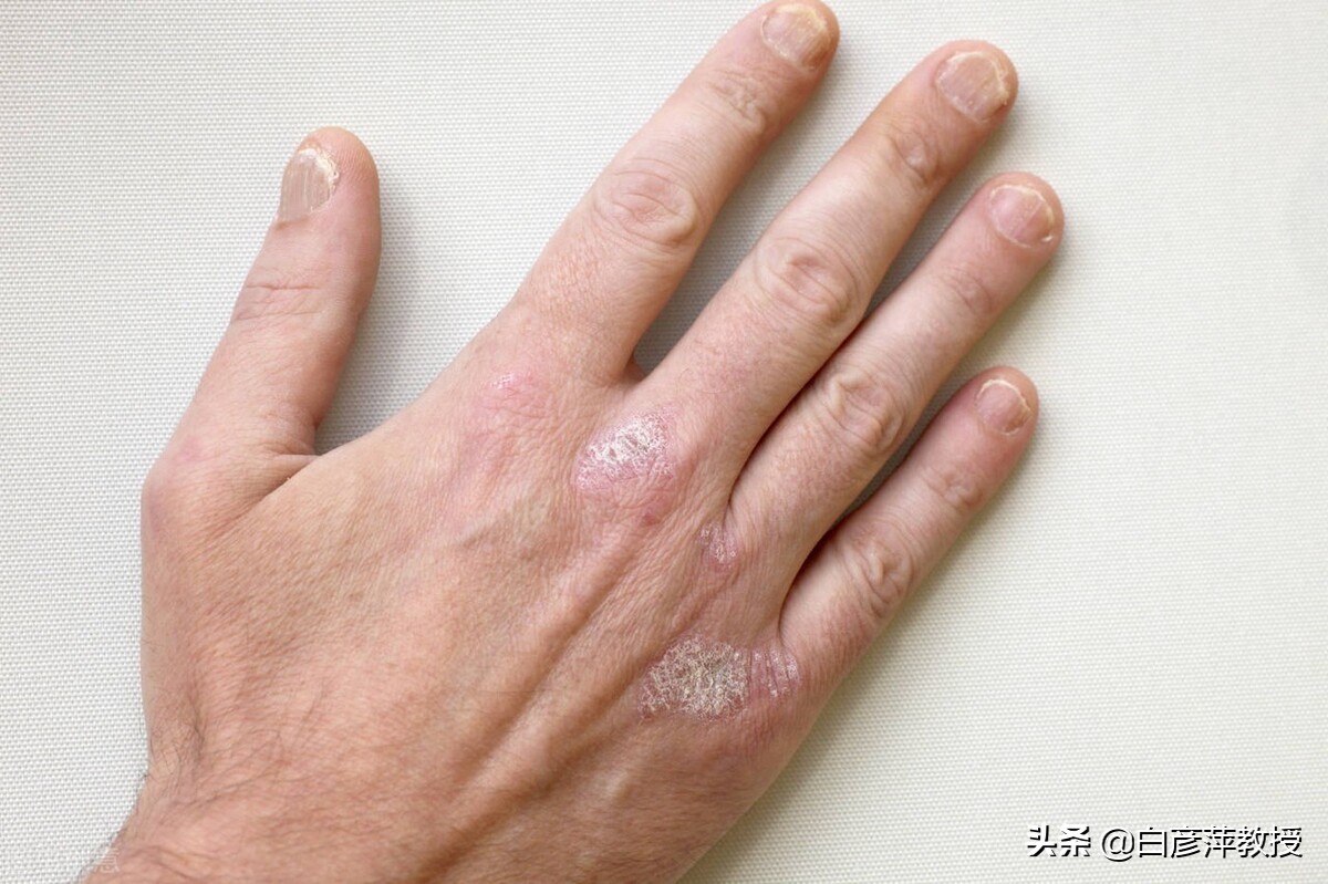灰指甲前期(灰指甲是灰色的吗?灰指甲真的会传染吗?皮肤科医生告诉你)
