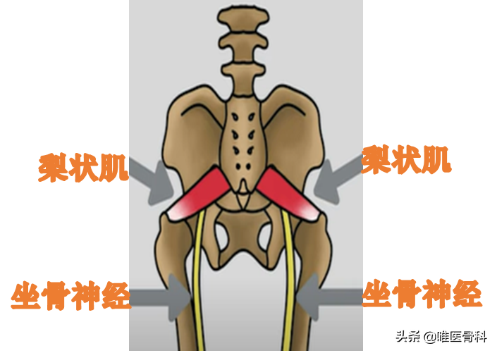 坐骨神经痛是什么引起的(为什么会「坐骨神经痛」？两大原因，一招区分)