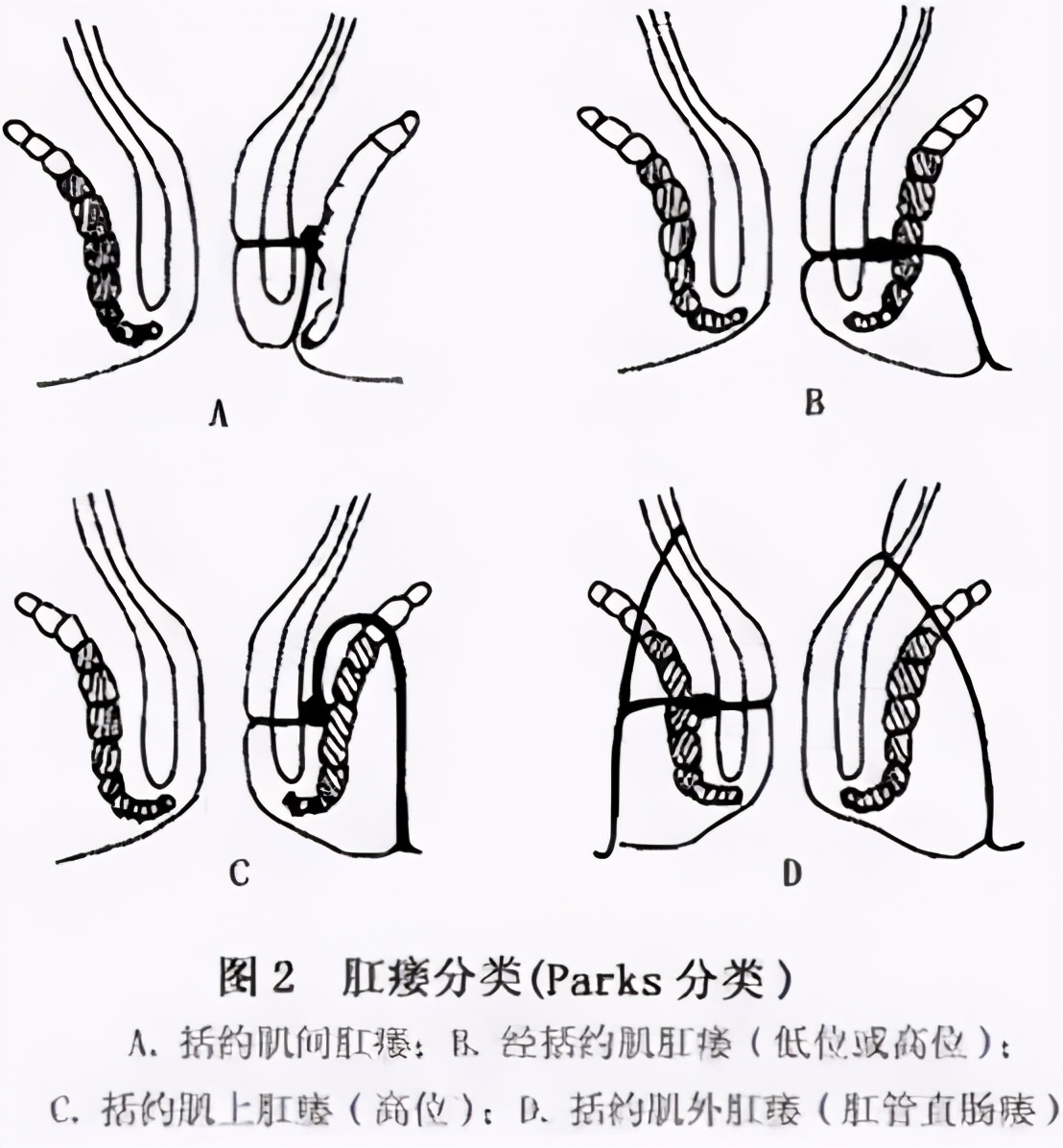 肛肠科患者与医生的真实对话，还原肛瘘的真相，让你不走弯路