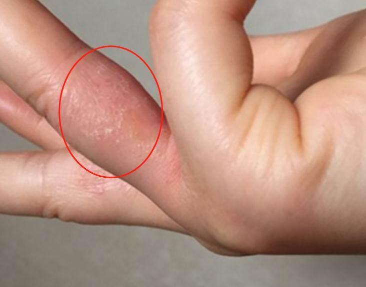 手指缝,脚趾缝,脚底板总长透明小水泡,很痒总想抠?一文说清