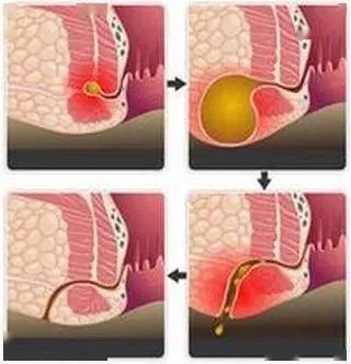 一顿小龙虾，屁股“被掏空”？肛周脓肿为啥找上门？