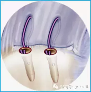 骨科专家释疑︱肩袖修补非要用锚钉吗？