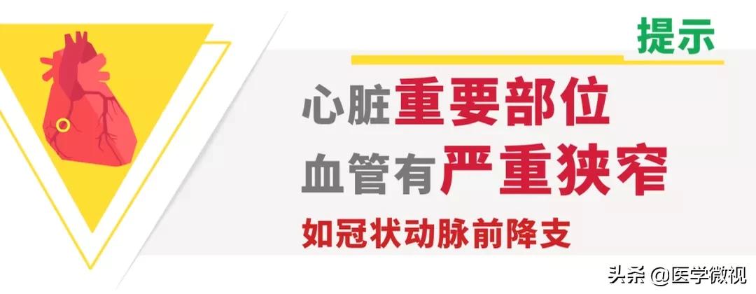 心脏支架降至700元！什么情况下，患者就需要做支架手术了？